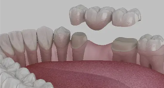 Dental Bridges