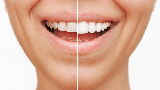 Crowns & Veneers