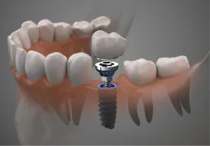 Dental implants in Frisco TX