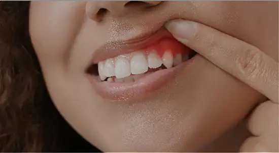 Gum Treatments