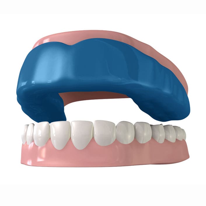 Custom dental mouth guard for night grinding and sports protection at Tribute Family Dentistry in Frisco, TX