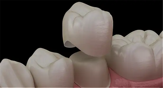 Crowns In One Day