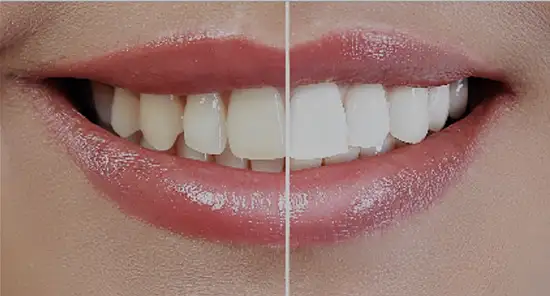 Teeth Whitening