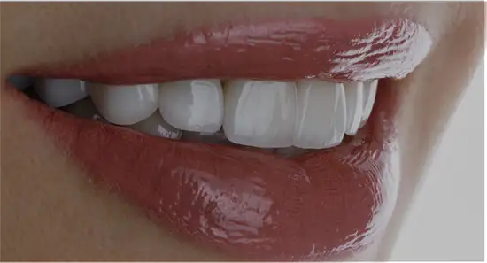 Veneers