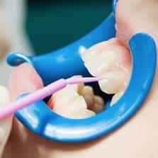 Protective Dental Sealants for Kids – Frisco Pediatric Dentist Dental sealants applied to protect children's molars at Tribute Family Dentistry in Frisco, TX