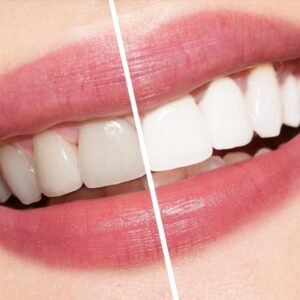 Teeth whitening results at Tribute Family Dentistry