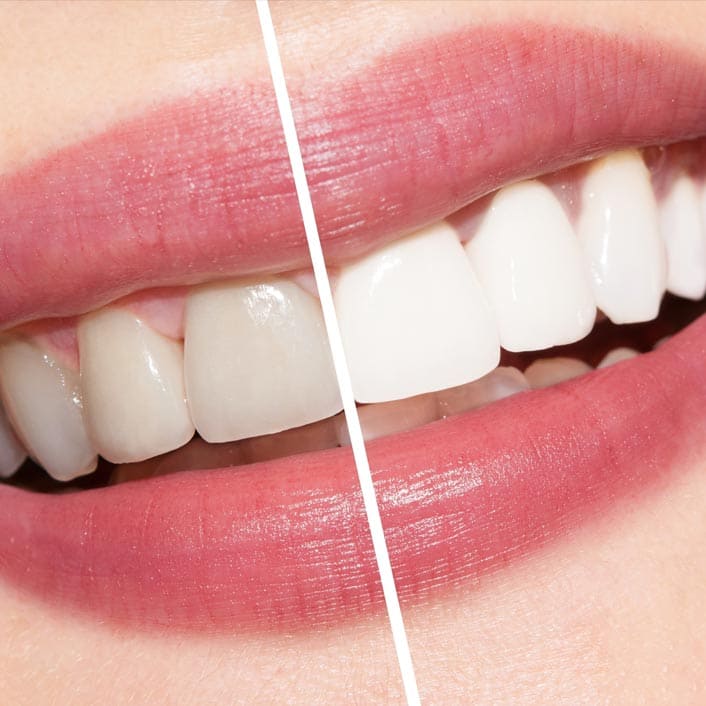 Before and After Teeth Whitening – Frisco Dentist 75034 Before and after teeth whitening results at Tribute Family Dentistry in Frisco TX 75034
