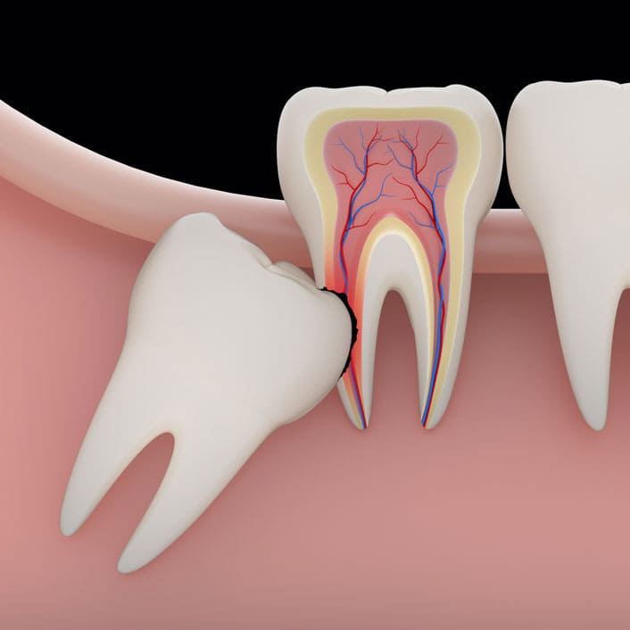 Wisdom Teeth Extractions Wisdom Teeth Extractions
