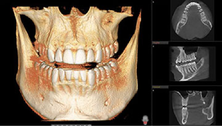 Candidate For Dental Implants