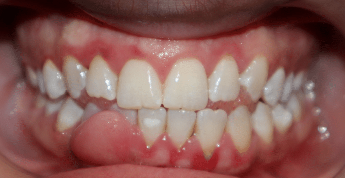 Gingival Abscess Picture