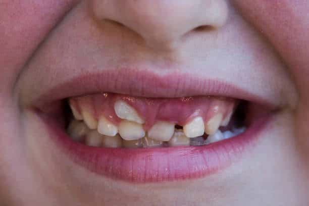 Shark Teeth Human