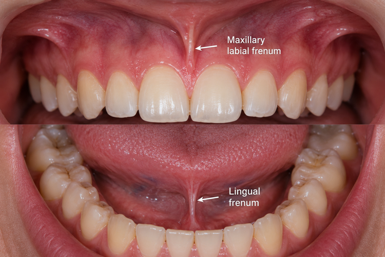 Labial and Lingual Frenum